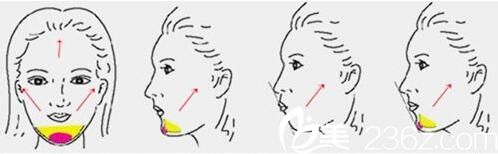 射頻除皺消除面部皺紋