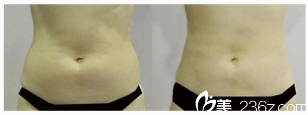 吸脂瘦腹部前后對(duì)比 吸脂瘦腹部前后對(duì)比