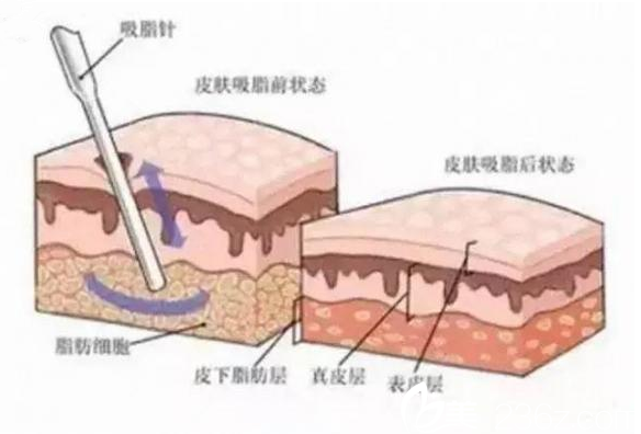 吸脂原理 吸脂原理