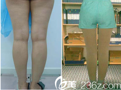 超龍吸脂瘦腿真人案例 超龍吸脂瘦腿真人案例