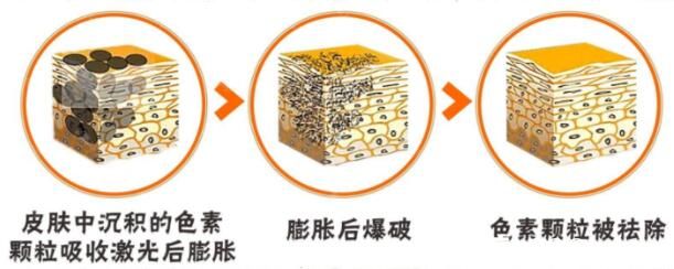 激光祛斑術(shù)后注意事項(xiàng)