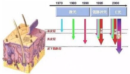 激光去紅血絲原理