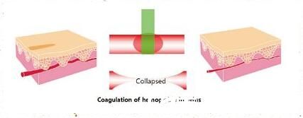 激光去紅血絲有副作用嗎？