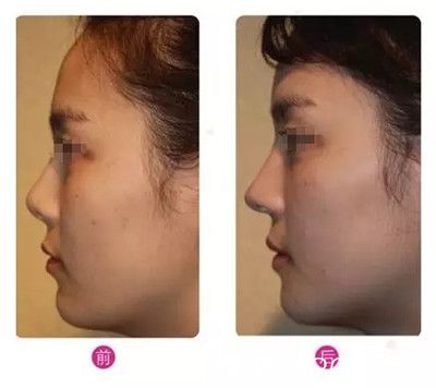 硅膠隆鼻術(shù)后對比效果