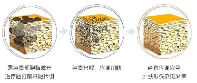 超皮秒美膚原理圖