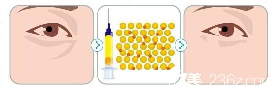 淚溝需要注意的事項(xiàng)