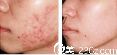 激光祛痘效果圖