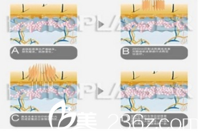 激光祛痘原理示意圖