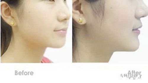 玻尿酸豐下巴案例對比