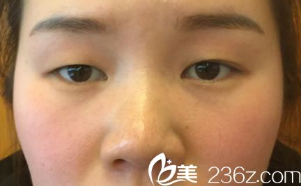 做完雙眼皮手術(shù)后注意事項