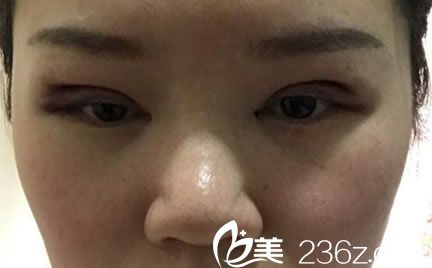 我做完雙眼皮手術(shù)當(dāng)天效果圖