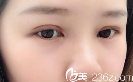 做完全切雙眼皮手術(shù)8天恢復(fù)效果圖