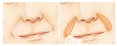 什么是鼻唇溝 什么是鼻唇溝