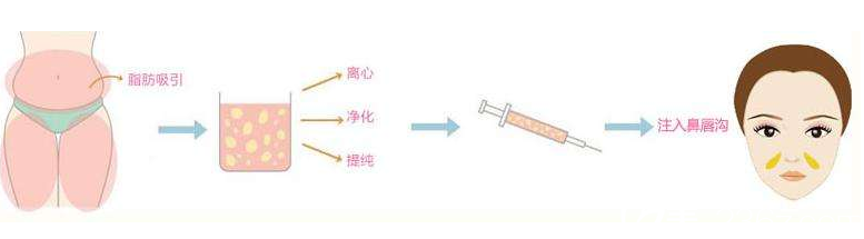 自體脂肪填充鼻唇溝 自體脂肪填充鼻唇溝