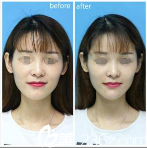 瑞藍(lán)玻尿酸填充鼻唇溝案例對比 瑞藍(lán)玻尿酸填充鼻唇溝案例對比