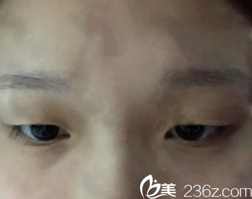 在嘉興曙光醫(yī)院做雙眼皮前 在嘉興曙光醫(yī)院做雙眼皮前