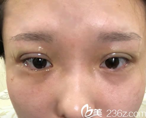 剛做完埋線雙眼皮手術(shù)的圖片 剛做完埋線雙眼皮手術(shù)的圖片