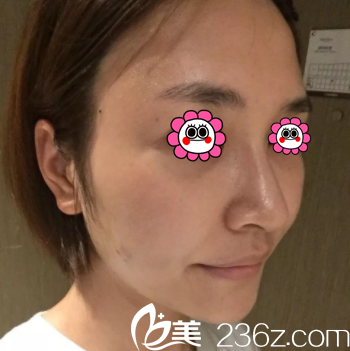 北京美萊趙峻賢給我做面部線雕第11天效果 北京美萊趙峻賢給我做面部線雕第11天效果