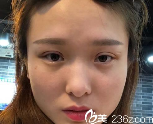 埋線雙眼皮手術(shù)3天恢復(fù)<span style= 埋線雙眼皮手術(shù)3天恢復(fù)<span style=