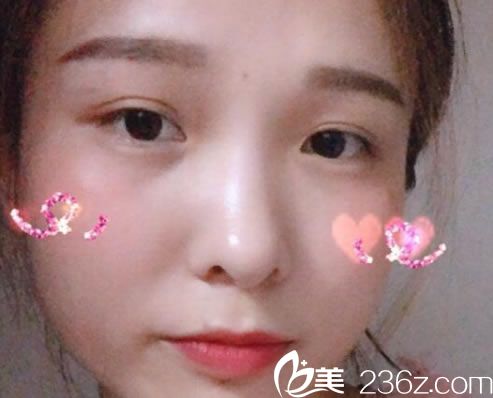 選擇嘉興曙光做埋線雙眼皮30天后 選擇嘉興曙光做埋線雙眼皮30天后