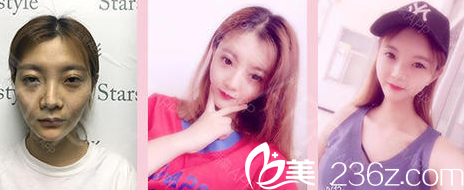 <!--<i data=20240703-sp></i>-->醫(yī)療美容診所自體脂肪填充案例分享 <!--<i data=20240703-sp></i>-->醫(yī)療美容診所自體脂肪填充案例分享