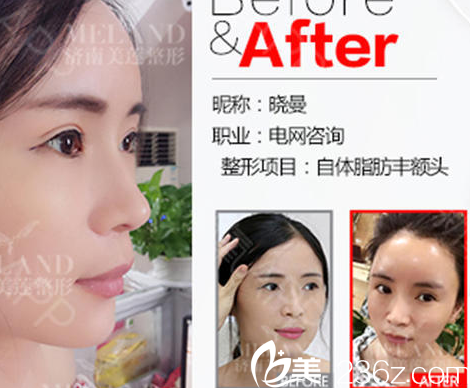 <!--<i data=20240703-sp></i>-->醫(yī)院自體脂肪填充案例 <!--<i data=20240703-sp></i>-->醫(yī)院自體脂肪填充案例