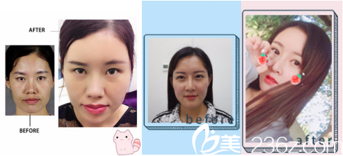 煙臺華怡醫(yī)學(xué)美容醫(yī)院自體脂肪填充案例 煙臺華怡醫(yī)學(xué)美容醫(yī)院自體脂肪填充案例