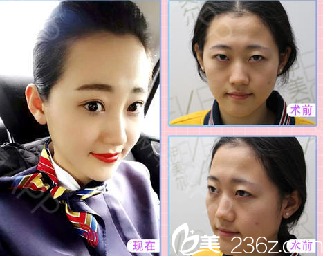 山東陽光美容整形醫(yī)院自體脂肪填充案例 山東陽光美容整形醫(yī)院自體脂肪填充案例