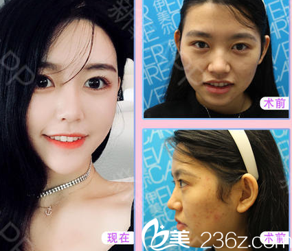 <!--<i data=20240703-sp></i>-->整形美容醫(yī)院自體脂肪填充案例 <!--<i data=20240703-sp></i>-->整形美容醫(yī)院自體脂肪填充案例