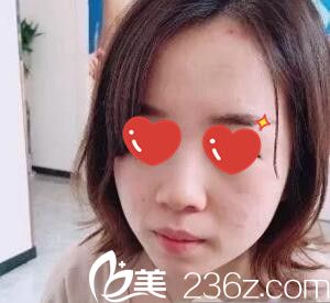 做鼻綜合+假體墊下巴術(shù)前照 做鼻綜合+假體墊下巴術(shù)前照