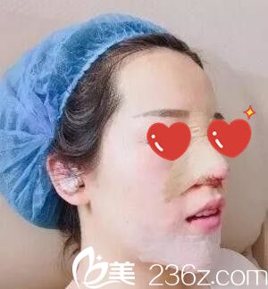 鼻綜合+假體墊下巴術(shù)后天 鼻綜合+假體墊下巴術(shù)后天