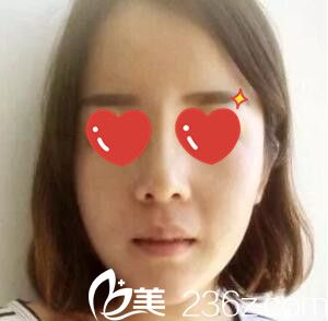 鼻綜合+假體墊下巴術(shù)后一周效果 鼻綜合+假體墊下巴術(shù)后一周效果