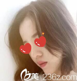 在郴州唯美整形醫(yī)院做了鼻綜合+假體墊下巴后我媽說她都快認(rèn)不出我了！