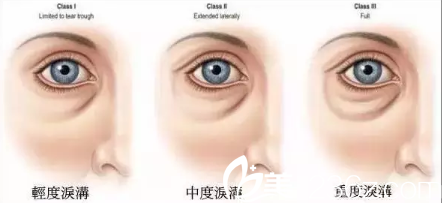 淚溝凹陷程度不同填充玻尿酸不同