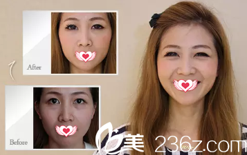 玻尿酸填充淚溝案例