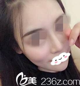 我在整形醫(yī)院做的假體隆鼻術(shù)后一個(gè)月，輕松擁有了自然的小翹鼻