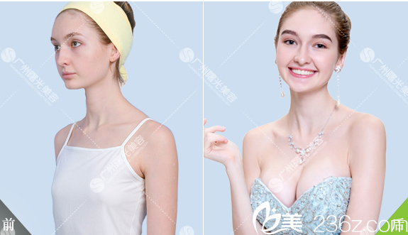 廣州曙光整形醫(yī)院劉永波做的假體隆胸對(duì)比案例
