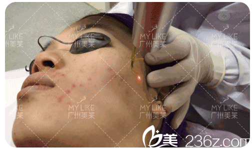 在廣州美萊做超皮秒祛斑的過(guò)程