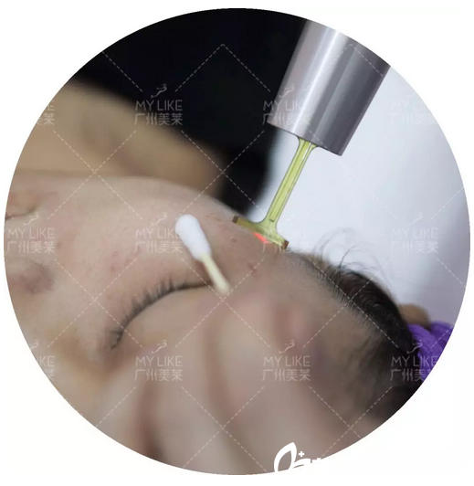 親身體驗(yàn)廣州美萊超皮秒祛斑過(guò)程