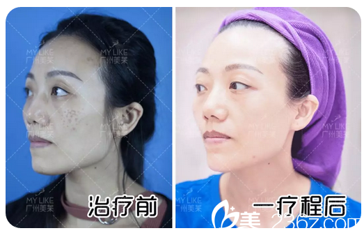在廣州美萊做完超皮秒祛斑一個(gè)療程效果圖