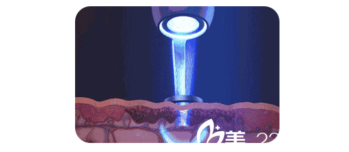 超皮秒祛斑原理圖