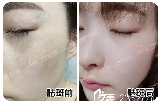 廣州美萊超皮秒祛斑真人案例效果對(duì)比圖