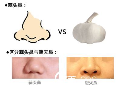 蒜頭鼻和朝天鼻的區(qū)別