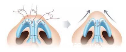 自體軟骨隆鼻矯正蒜頭鼻