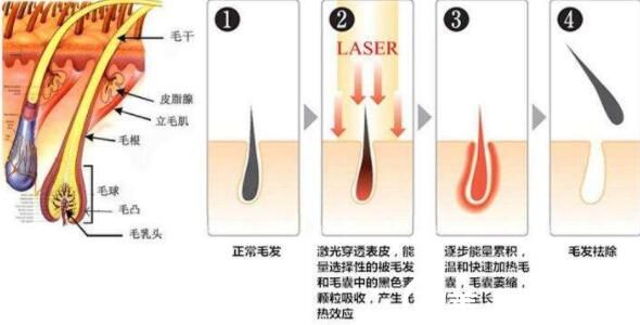 超冰的脫毛手術(shù)原理