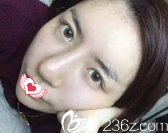 假體隆鼻失敗鼻頭寬大鼻梁歪斜 假體隆鼻失敗鼻頭寬大鼻梁歪斜