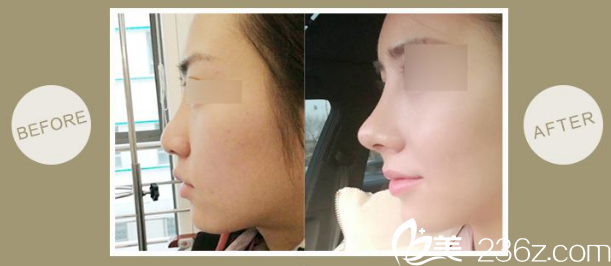 做鼻尖選擇用自體軟骨做前后對比案例