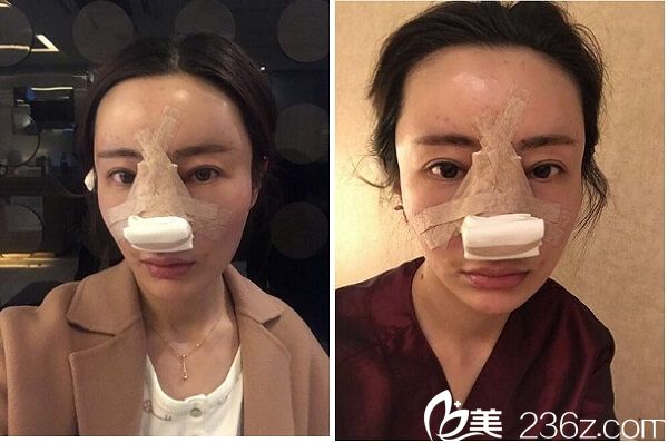 在韓國碧夏整形做完手術(shù)后當(dāng)天 在韓國碧夏整形做完手術(shù)后當(dāng)天