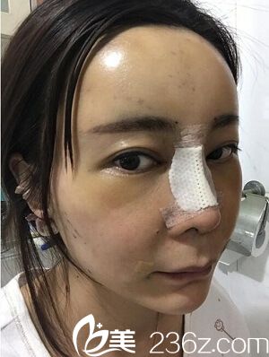 自體軟骨隆鼻2天了 自體軟骨隆鼻2天了