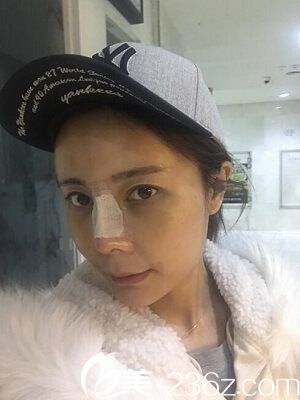 自體脂肪填充全臉后3天 自體脂肪填充全臉后3天